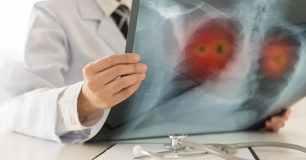 Can new combination immunotherapy help people with lung cancer who are resistant to previous treatment?