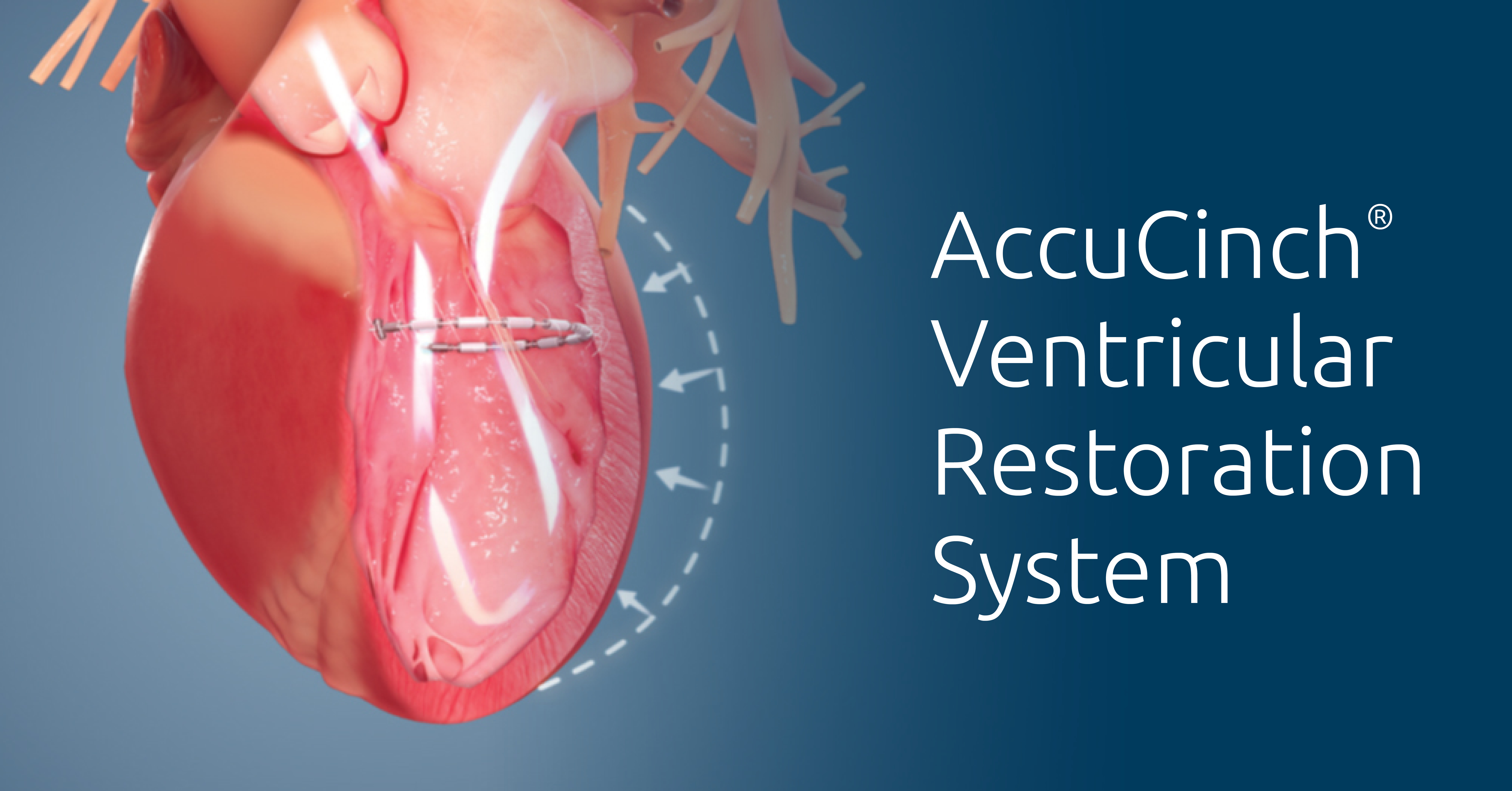 Aurora St. Luke’s is first in state to join study of novel therapy to address heart failure