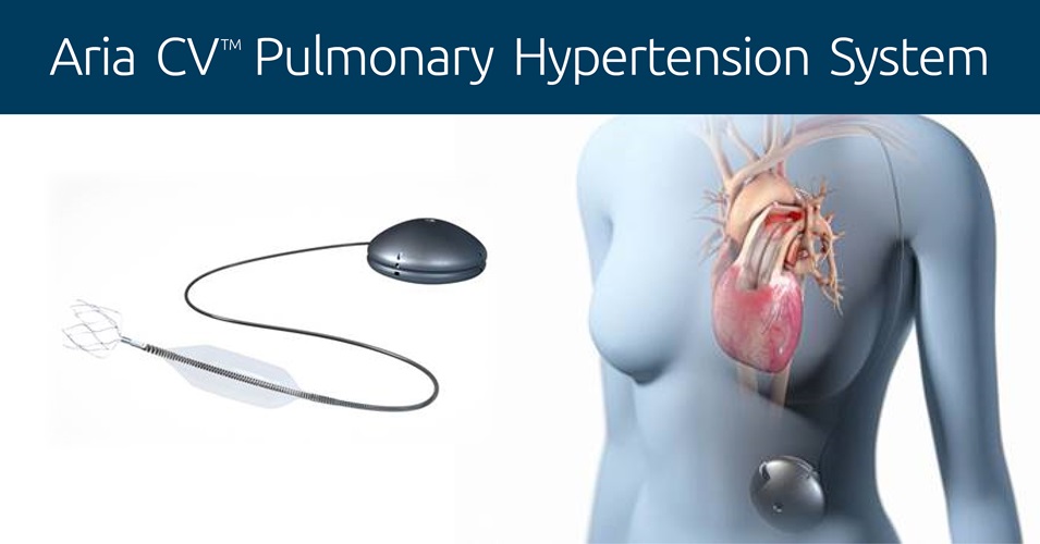 Aurora St. Luke’s is first site in state to study device to treat pulmonary arterial hypertension