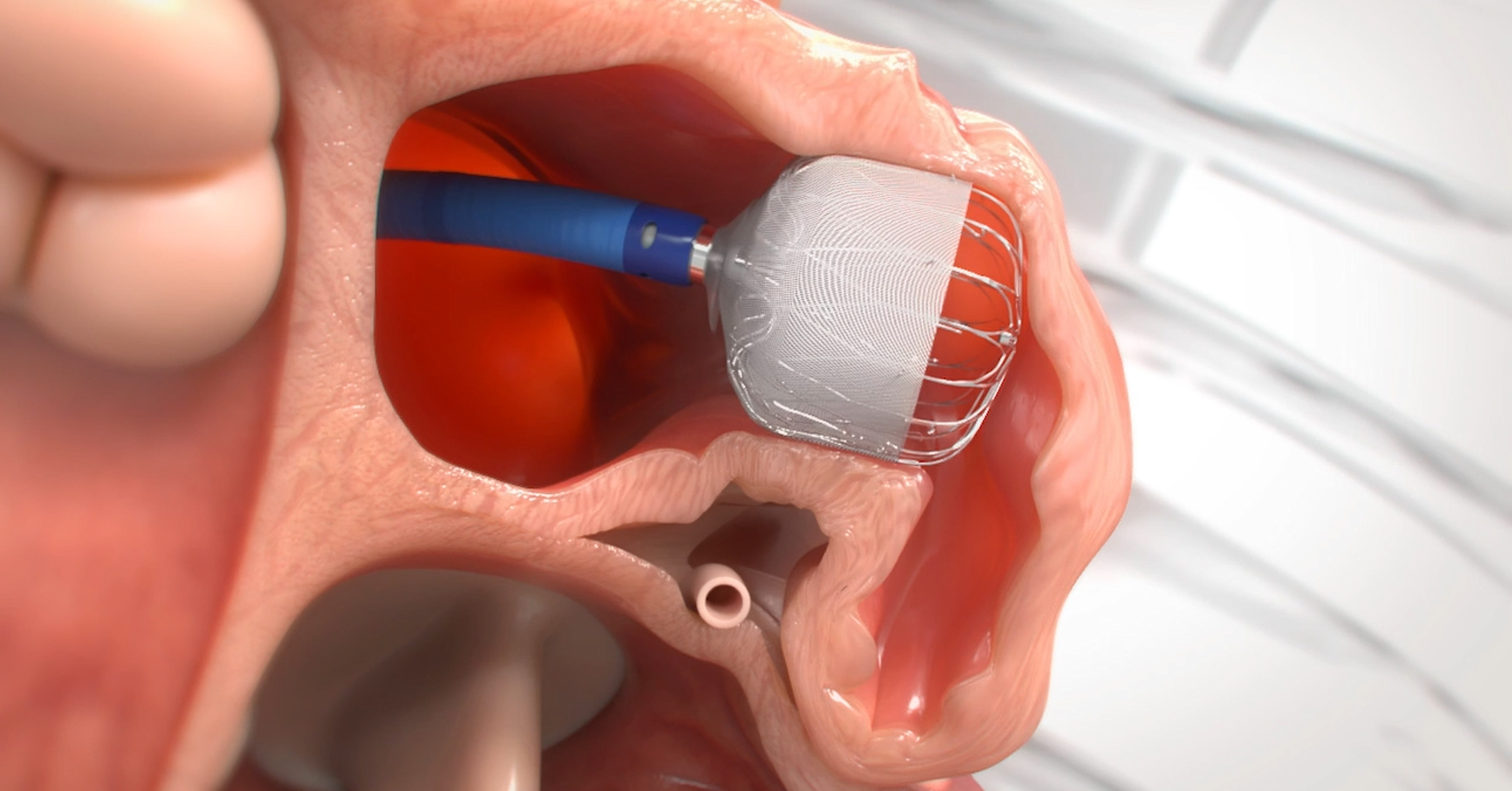 /research/advocate-aurora/research-news/advocate-aurora-cancer-clinics-are-first-in-wisconsin-to-join-multiple-myeloma-clinical-trial