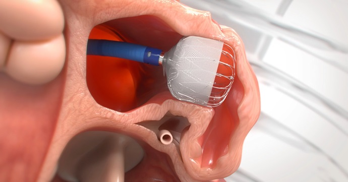 /research/advocate-aurora/research-news/advocate-aurora-cancer-clinics-are-first-in-wisconsin-to-join-multiple-myeloma-clinical-trial