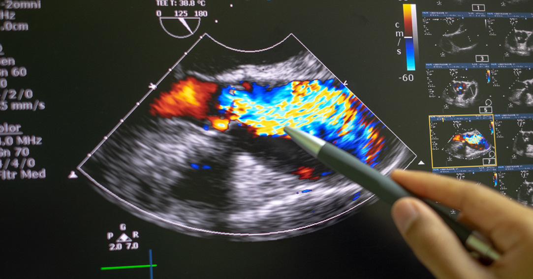 Advocate Aurora Research Institute joins study of potential first treatment to slow aortic stenosis