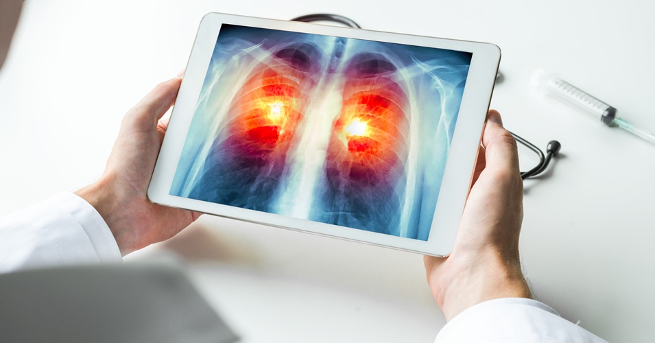 Advocate Aurora Research Institute clinical trial examines immunotherapy drug to treat lung cancer